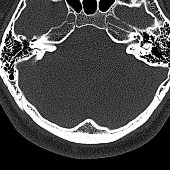 File:Normal CT of the cervical spine (Radiopaedia 53322-59305 Axial bone window 2).jpg