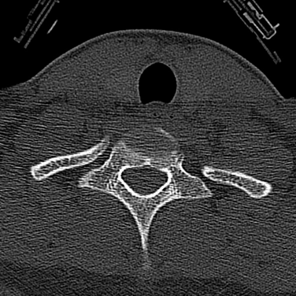 Normal CT of the cervical spine (Radiopaedia 53322-59305 Axial bone window 226).jpg