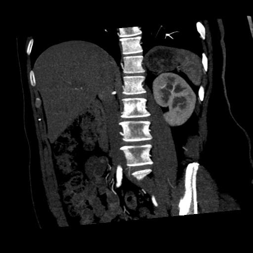 File:Normal CT renal artery angiogram (Radiopaedia 38727-40889 C 14).png