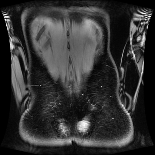 Normal MRI abdomen in pregnancy (Radiopaedia 88001-104541 M 124).jpg