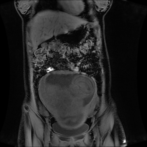 Normal MRI abdomen in pregnancy (Radiopaedia 88001-104541 M 45).jpg