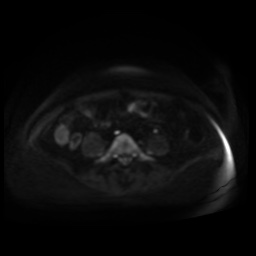 Normal MRI abdomen in pregnancy (Radiopaedia 88005-104548 Axial DWI 69).jpg