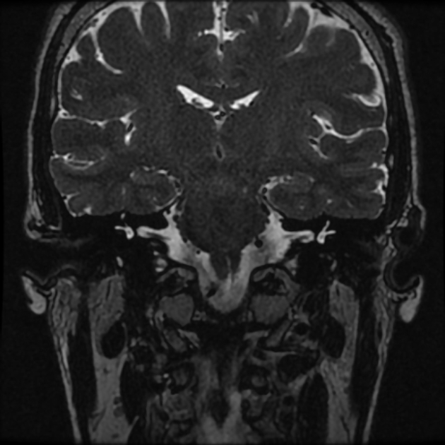 Normal MRI petrous (Radiopaedia 91317-108949 Coronal T2 50).jpg