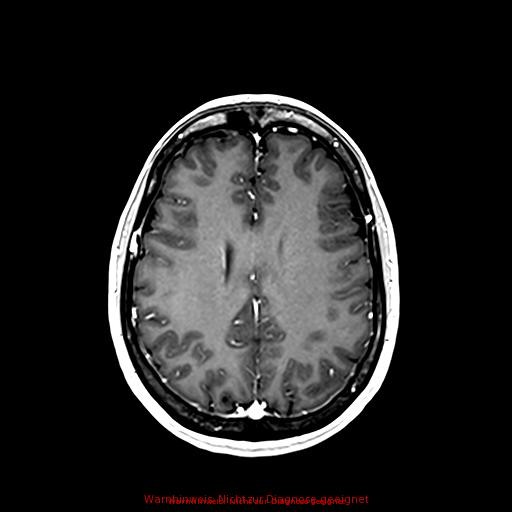 Normal adult brain MRI (non-enhanced and contrast-enhanced) (Radiopaedia 75262-86379 Axial T1 C+ 128).jpg
