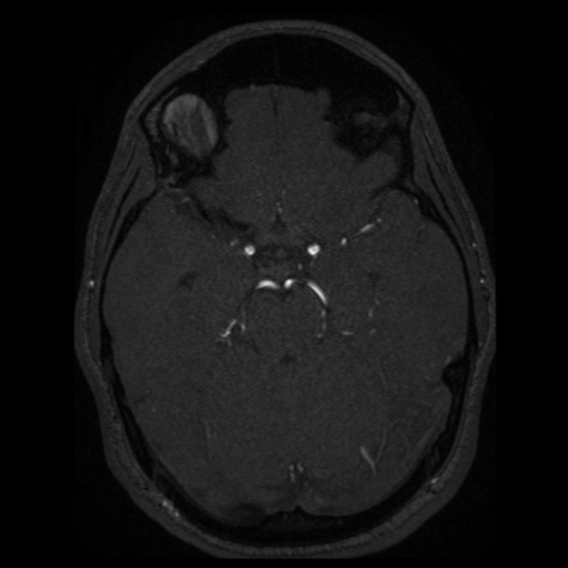 Normal brain MRA (Radiopaedia 41046-43793 Axial MRA 58).png