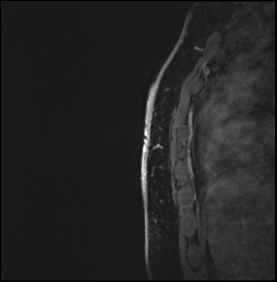 Normal breast MRI - dense breasts (Radiopaedia 80454-93850 I 165).jpg