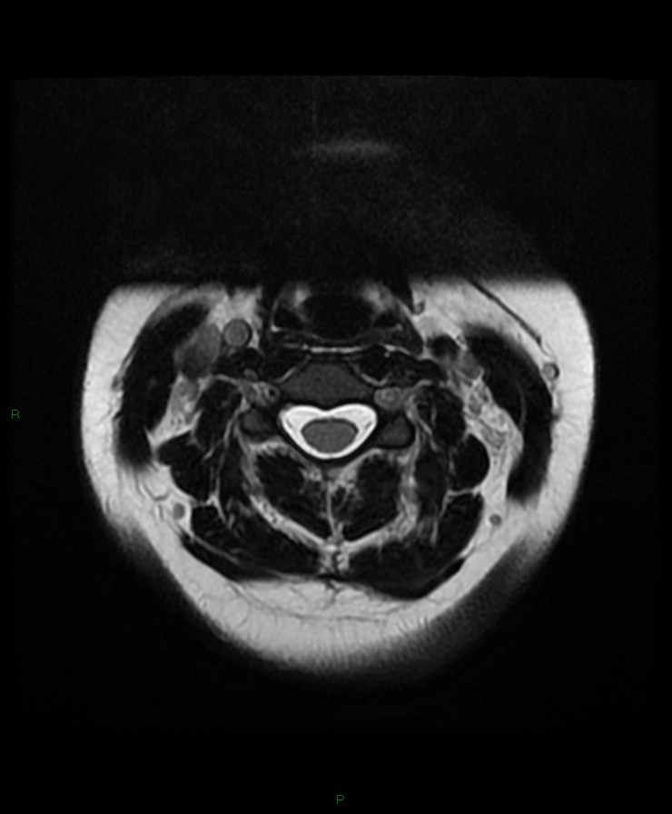 Normal cervical spine MRI (Radiopaedia 80146-93454 Axial T2 32).jpg