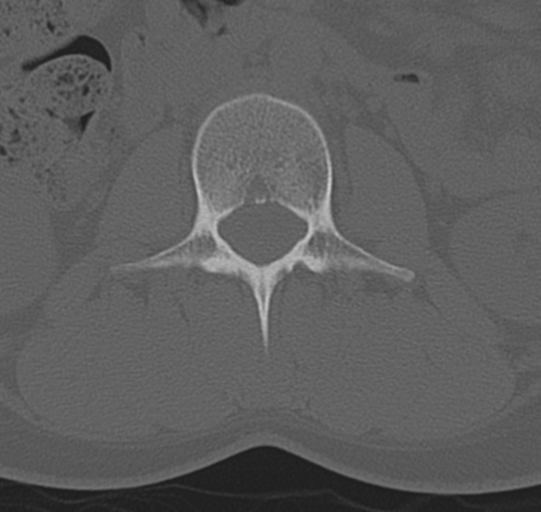 File:Normal lumbar spine CT (Radiopaedia 46533-50986 Axial bone window 24).png
