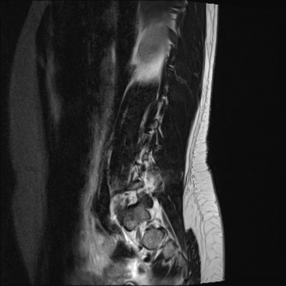 File:Normal lumbar spine MRI- 3 T (Radiopaedia 53280-59250 Sagittal T2 5).jpg