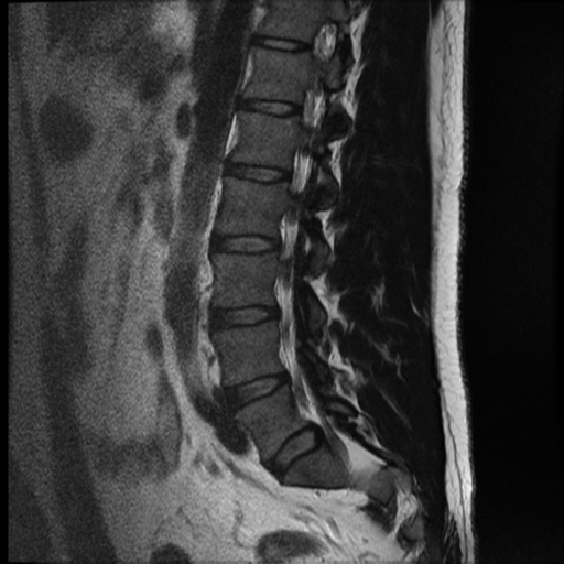 File:Normal lumbar spine MRI (Radiopaedia 35543-37039 Sagittal T2 4).png