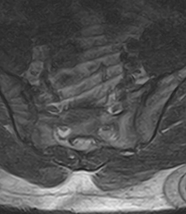 Normal lumbar spine MRI - low-field MRI scanner (Radiopaedia 40976-43699 Axial T2 99).jpg
