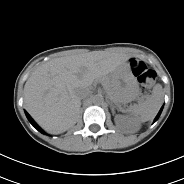 File:Normal multiphase CT liver (Radiopaedia 38026-39996 Axial non-contrast 16).jpg