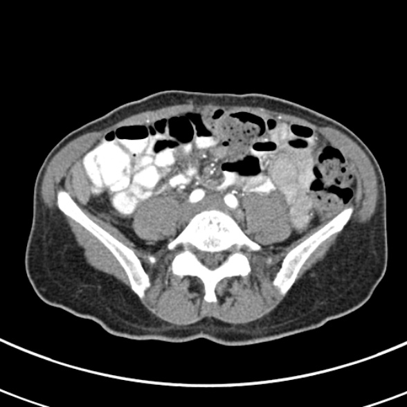 File:Normal multiphase CT liver (Radiopaedia 38026-39996 B 59).jpg