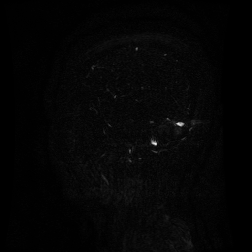Normal noncontrast MR venography (Radiopaedia 87578-103957 A 143).jpg