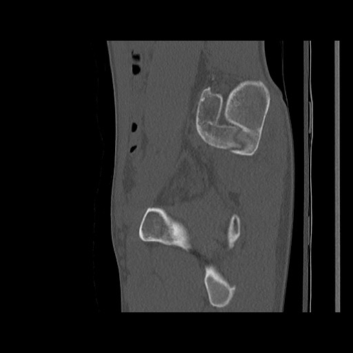 Normal pelvis (Radiopaedia 51473-57238 Sagittal bone window 100).jpg