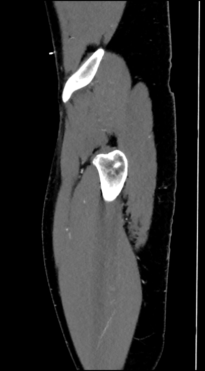 Normal pelvis CT angiogram (Radiopaedia 84966-100481 C 99).jpg