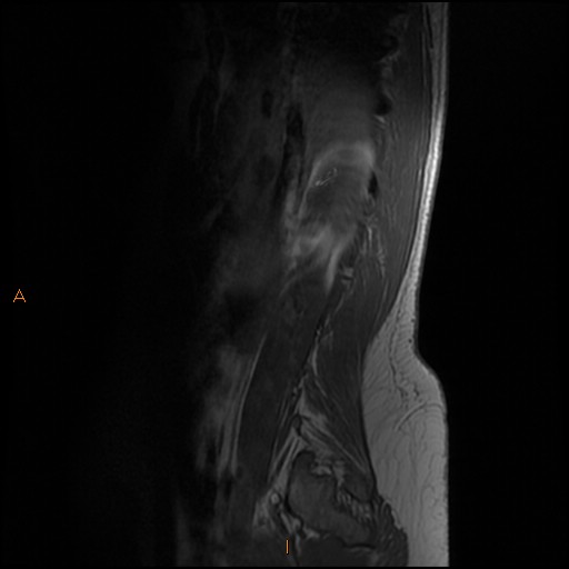 File:Normal spine MRI (Radiopaedia 77323-89408 Sagittal T1 1).jpg
