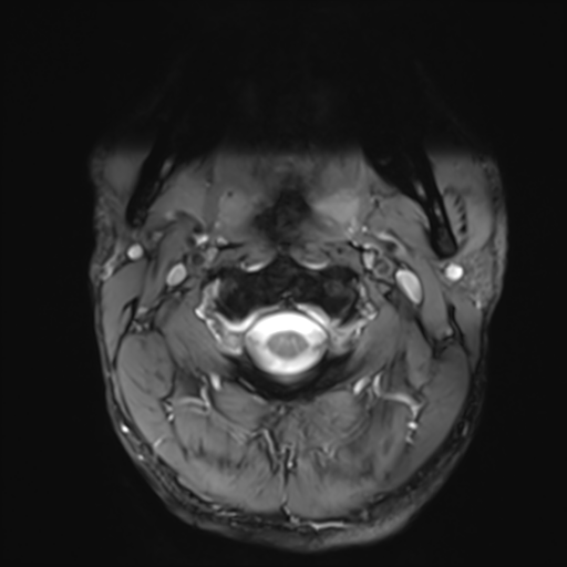 File:Normal trauma cervical spine (Radiopaedia 41017-43762 Axial T2 1).png