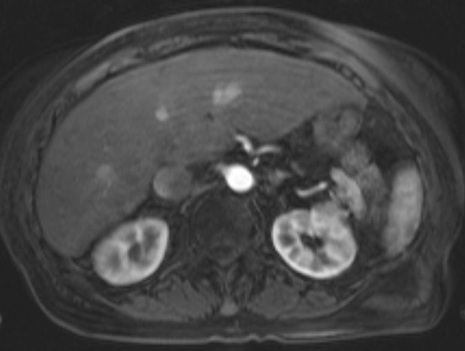 File:Nutmeg appearance of the liver (Radiopaedia 22879-22904 Axial T1 C+ fat sat 1).jpg
