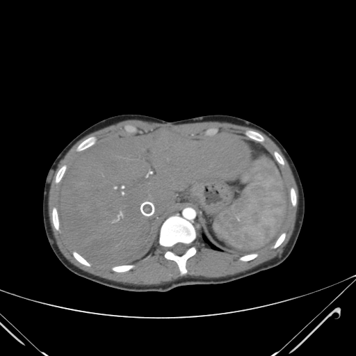 File:Nutmeg liver- Budd-Chiari syndrome (Radiopaedia 46234-50635 A 18).png