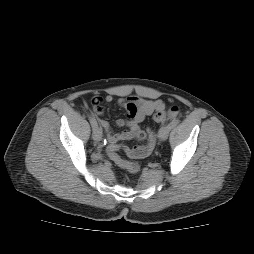 File:Obstructed kidney with perinephric urinoma (Radiopaedia 26889-27067 Axial non-contrast 44).jpg
