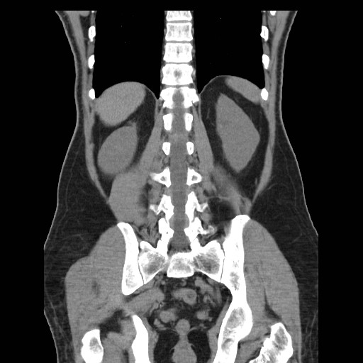 File:Obstructed kidney with perinephric urinoma (Radiopaedia 26889-27067 Coronal non-contrast 23).jpg