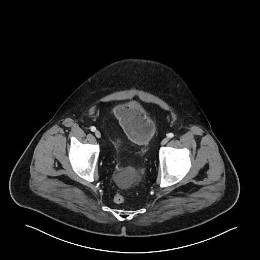 Obstructing sigmoid adenocarcinoma (Radiopaedia 58465-65619 A 146).jpg
