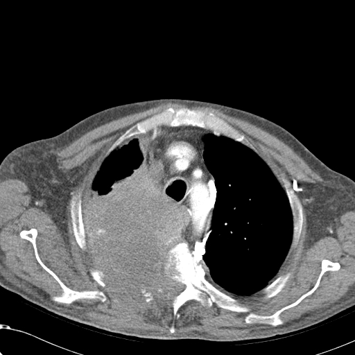 File:Obstructive superior vena cava tumor thrombus (Radiopaedia 28046-28306 A 13).jpg