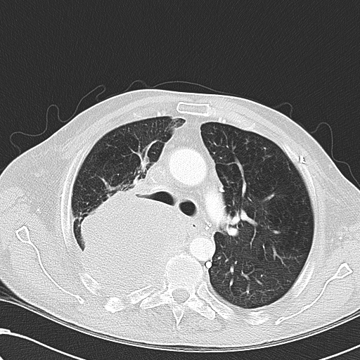 File:Obstructive superior vena cava tumor thrombus (Radiopaedia 28046-28306 Axial lung window 20).jpg