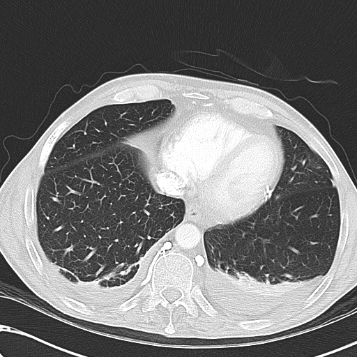 File:Obstructive superior vena cava tumor thrombus (Radiopaedia 28046-28306 Axial lung window 42).jpg