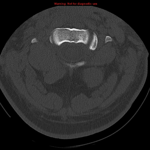 File:Occipital condyle fracture (Radiopaedia 18366-18208 Axial bone window 22).jpg