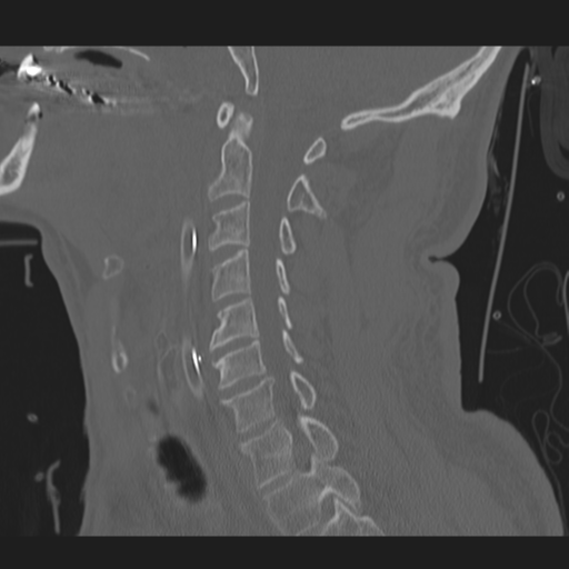 File:Occipital condyle fracture (Radiopaedia 33467-34517 Sagittal bone window 31).png