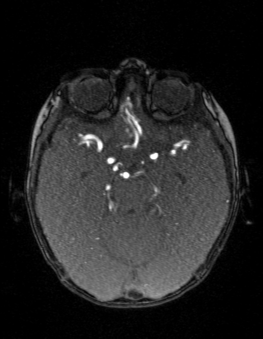Occipital horn syndrome (Radiopaedia 14255-14129 MRA 59).jpg
