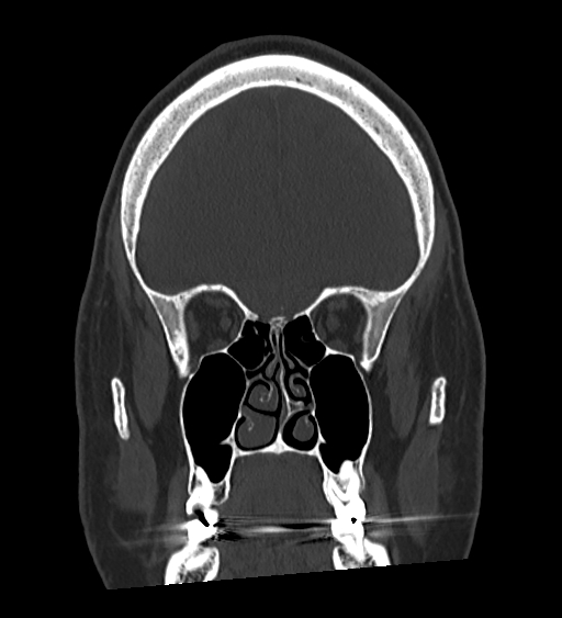 Occipital spur and Currarino type A atlas anomaly (Radiopaedia 87027-103285 Coronal bone window 52).jpg