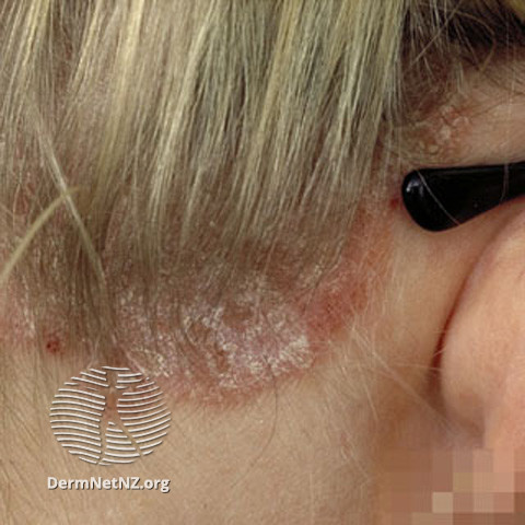 File:Psoriasis © R Suhonen (DermNet NZ hair-nails-sweat-s-psoriasis-scalp).jpg