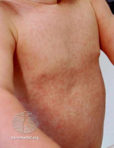 File:Rubella rash (DermNet NZ viral-rubella3).jpg