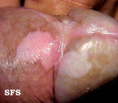 File:Vitiligo (Dermatology Atlas 9).jpg