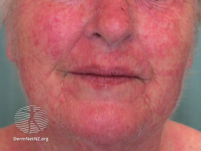 File:(DermNet NZ dermatitis-acd-face-2435).jpg