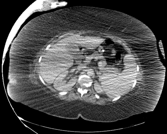 File:Abdominal abscess - pre and post percutaneous drainage (Radiopaedia 60209-67816 Axial 65).png