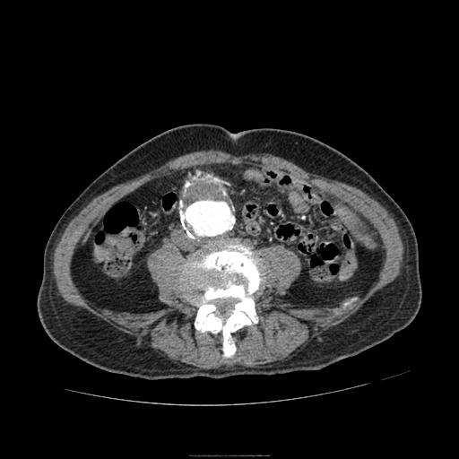 File:Abdominal aortic aneurysm (Radiopaedia 13341-13340 Axial C+ arterial phase 137).jpg