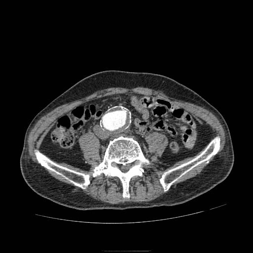 Abdominal aortic aneurysm (Radiopaedia 13341-13340 Axial C+ arterial phase 149).jpg