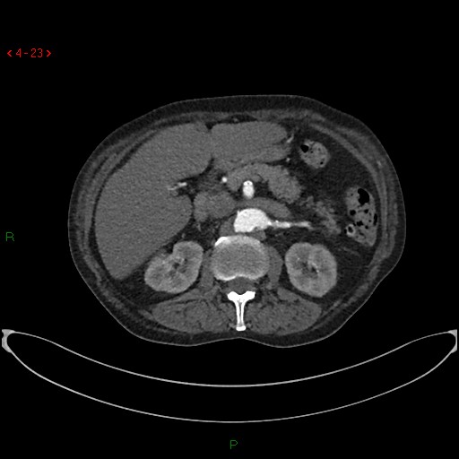 File:Abdominal aortic aneurysm (Radiopaedia 16155-15834 Axial C+ arterial phase 3).jpg