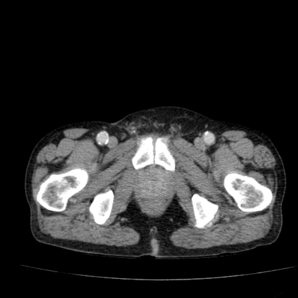 Abdominal aortic aneurysm (Radiopaedia 29248-29660 Axial C+ portal venous phase 64).jpg