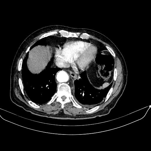 File:Abdominal aortic aneurysm (Radiopaedia 67117-76452 Axial C+ arterial phase 13).jpg