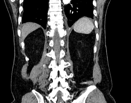 Abdominal aortic aneurysm (Radiopaedia 67117-76452 Coronal C+ arterial phase 88).jpg