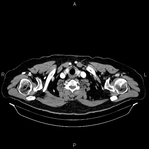 Abdominal aortic aneurysm (Radiopaedia 83094-97462 Axial renal cortical phase 1).jpg