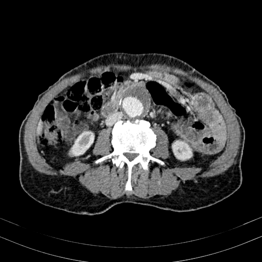 File:Abdominal aortic aneurysm (Radiopaedia 83581-98689 Axial C+ portal venous phase 61).jpg