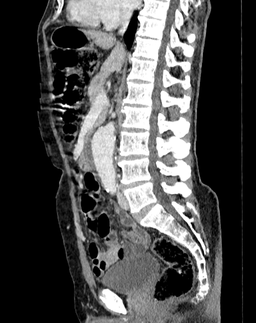 Abdominal aortic aneurysm (Radiopaedia 83581-98689 Sagittal C+ portal venous phase 46).jpg