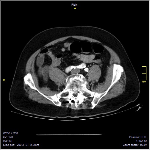 Abdominal aortic aneurysm with thrombus fissuration (Radiopaedia 47340-51926 Axial C+ arterial phase 47).jpg