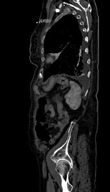 Abdominal aortic aneurysm with thrombus fissuration (Radiopaedia 73192-83919 Sagittal C+ arterial phase 18).jpg
